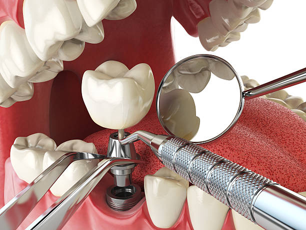 Best Knocked-Out Tooth (Avulsed Tooth) Treatment in La Luz, NM